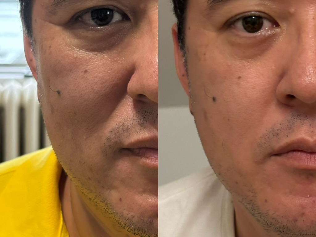使用前後對比,4 週——男性,40 代中,眼下與臉頰(未修圖)