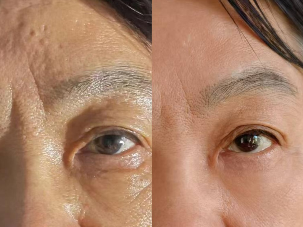 使用前後對比,4 週——女性,50 代,眼周(未修圖)