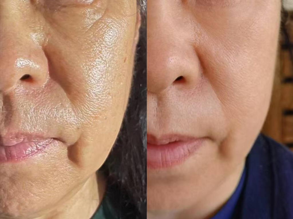 使用前後對比,4 週——女性,50 代,臉頰與法令紋(未修圖)